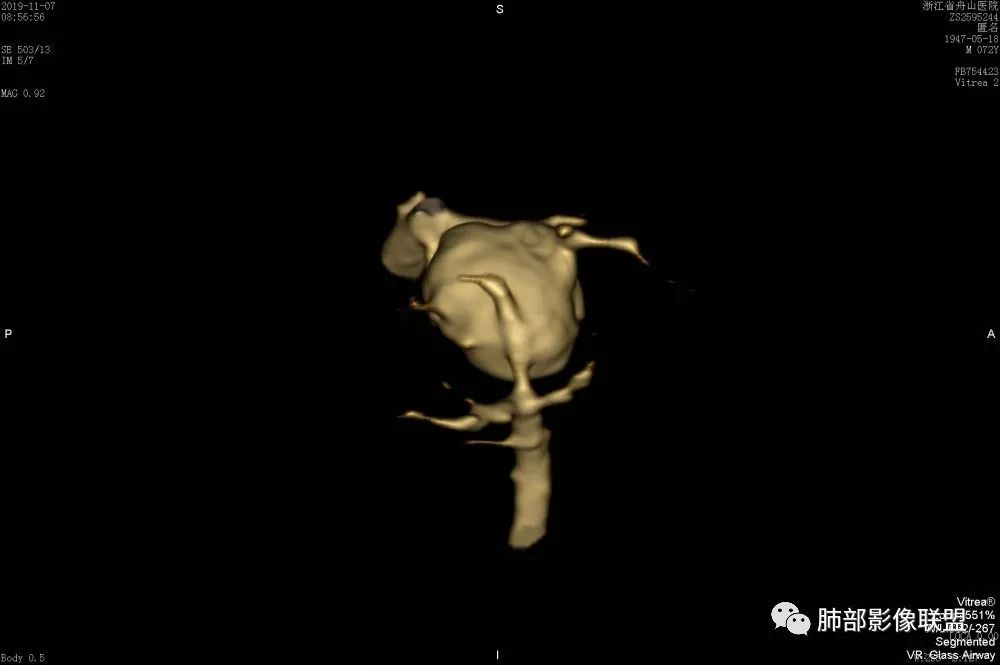 【病例】一眼识破的肺部新生物4例CT影像