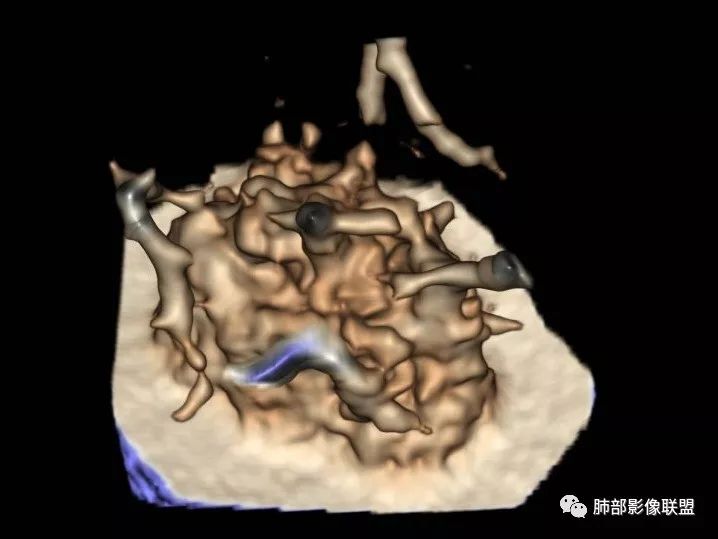 【病例】一眼识破的肺部新生物4例CT影像