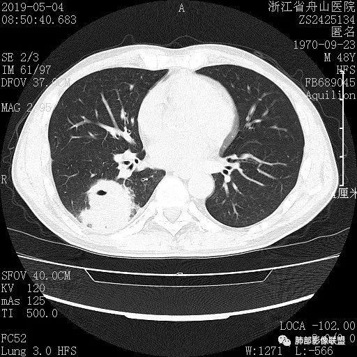 【病例】一眼识破的肺部新生物4例CT影像