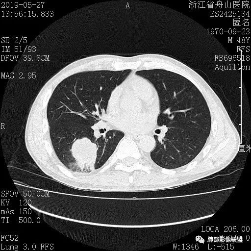 【病例】一眼识破的肺部新生物4例CT影像