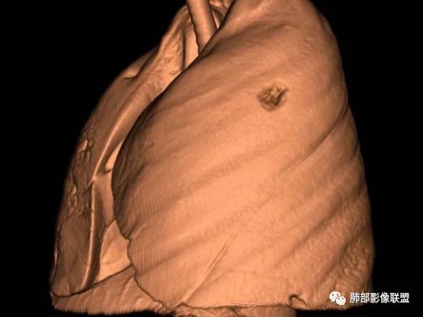 【病例】一眼识破的肺部新生物4例CT影像