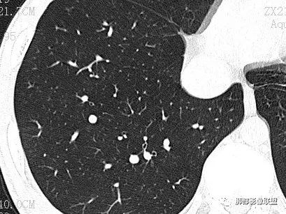 【病例】一眼识破的肺部新生物4例CT影像