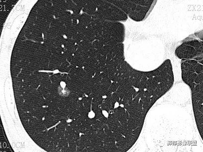 【病例】一眼识破的肺部新生物4例CT影像