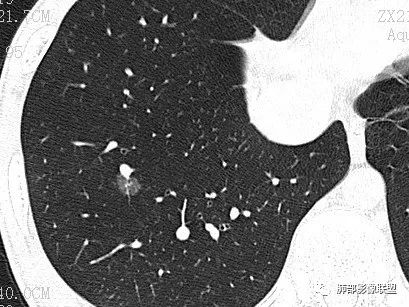 【病例】一眼识破的肺部新生物4例CT影像