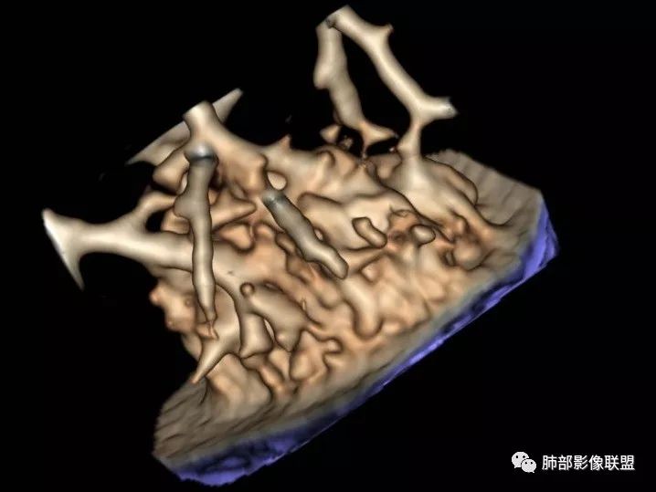 【病例】一眼识破的肺部新生物4例CT影像