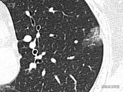 【病例】一眼识破的肺部新生物4例CT影像