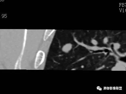 【病例】一眼识破的肺部新生物4例CT影像