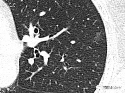 【病例】一眼识破的肺部新生物4例CT影像
