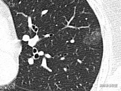 【病例】一眼识破的肺部新生物4例CT影像
