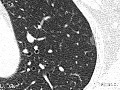 【病例】一眼识破的肺部新生物4例CT影像