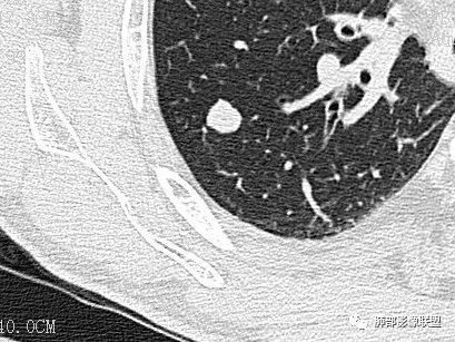 【病例】一眼识破的肺部新生物4例CT影像