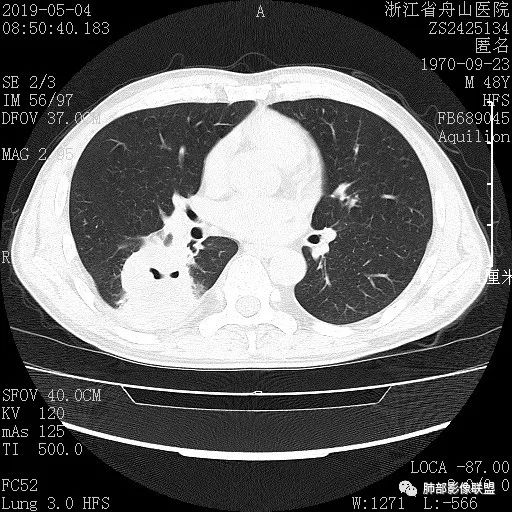 【病例】一眼识破的肺部新生物4例CT影像