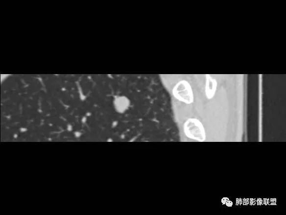 【病例】一眼识破的肺部新生物4例CT影像