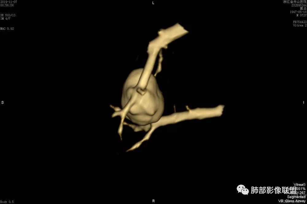 【病例】一眼识破的肺部新生物4例CT影像