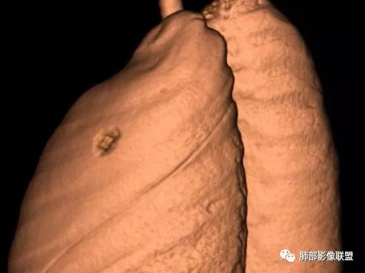 【病例】一眼识破的肺部新生物4例CT影像