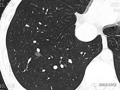 【病例】一眼识破的肺部新生物4例CT影像