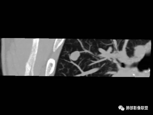 【病例】一眼识破的肺部新生物4例CT影像