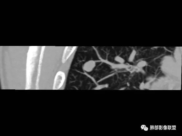 【病例】一眼识破的肺部新生物4例CT影像