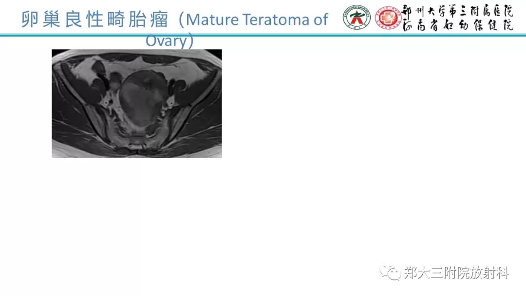 【病例】卵巢未成熟畸胎瘤1例MR影像 【病例】卵巢未成熟畸胎瘤1例MR影像