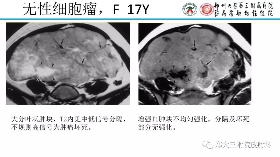 【病例】卵巢未成熟畸胎瘤1例MR影像 【病例】卵巢未成熟畸胎瘤1例MR影像
