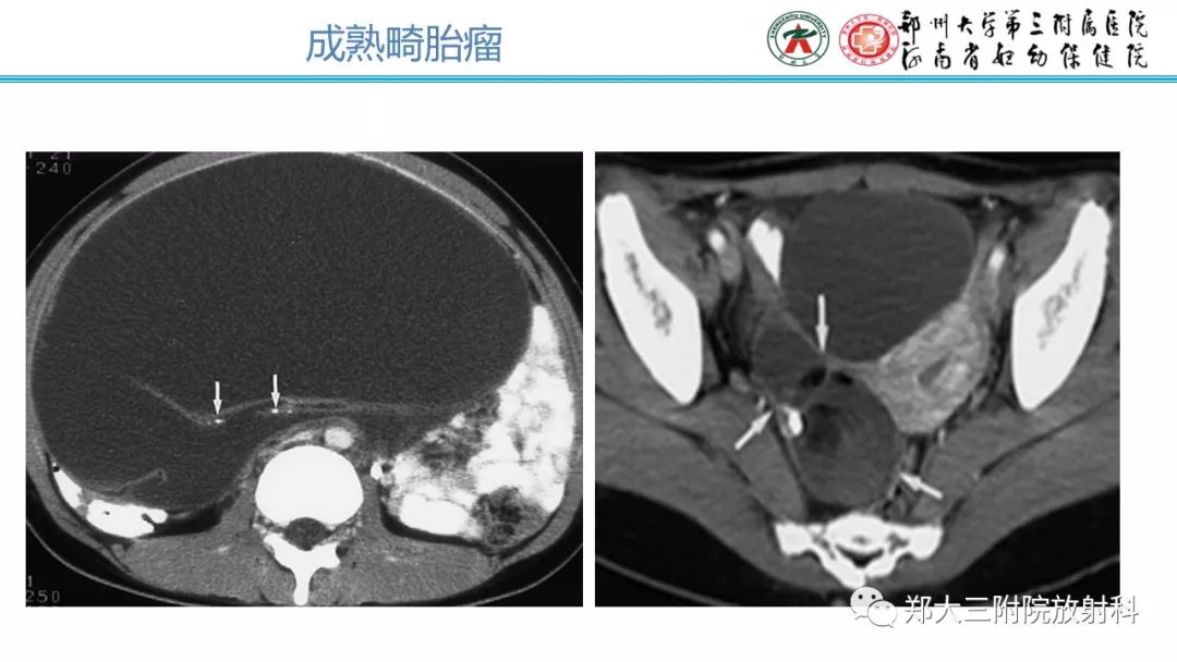 【病例】卵巢未成熟畸胎瘤1例MR影像 【病例】卵巢未成熟畸胎瘤1例MR影像