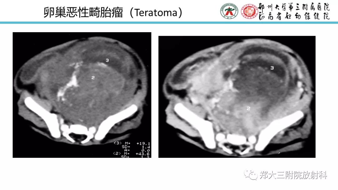 【病例】卵巢未成熟畸胎瘤1例MR影像 【病例】卵巢未成熟畸胎瘤1例MR影像