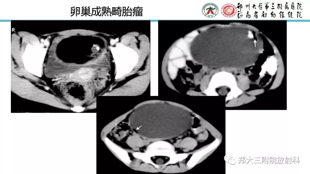 【病例】卵巢未成熟畸胎瘤1例MR影像 【病例】卵巢未成熟畸胎瘤1例MR影像