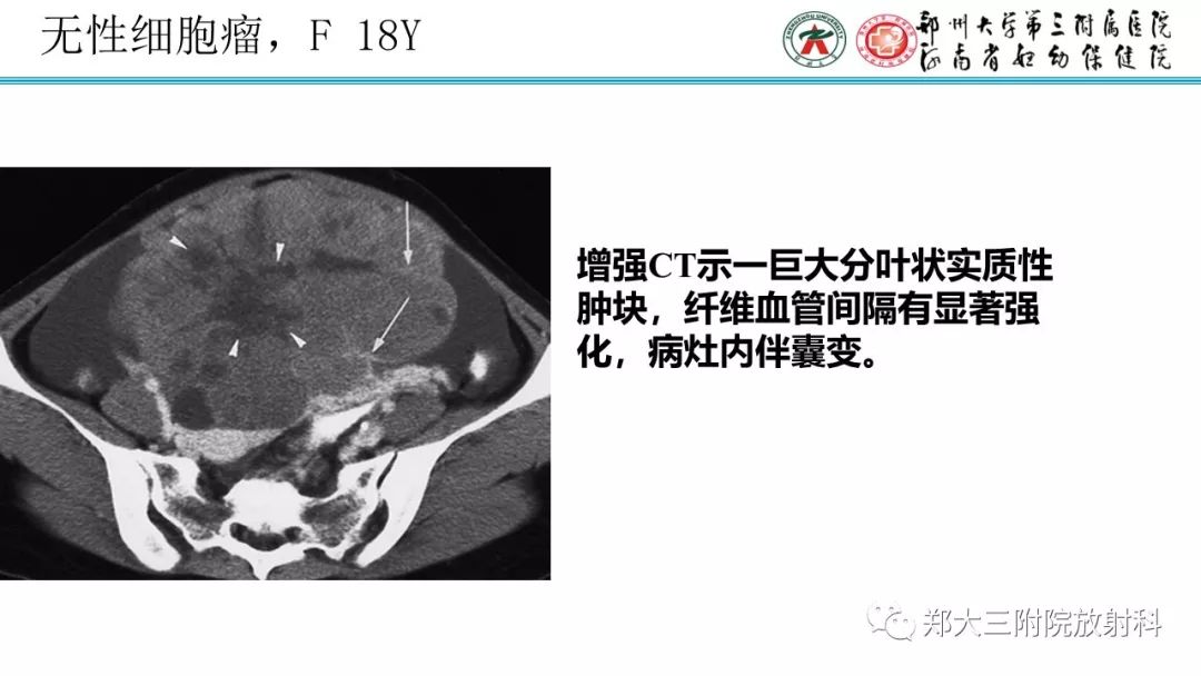 【病例】卵巢未成熟畸胎瘤1例MR影像 【病例】卵巢未成熟畸胎瘤1例MR影像