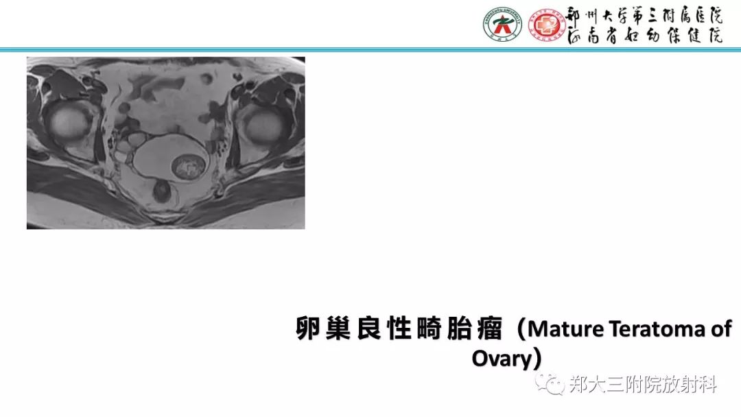 【病例】卵巢未成熟畸胎瘤1例MR影像 【病例】卵巢未成熟畸胎瘤1例MR影像