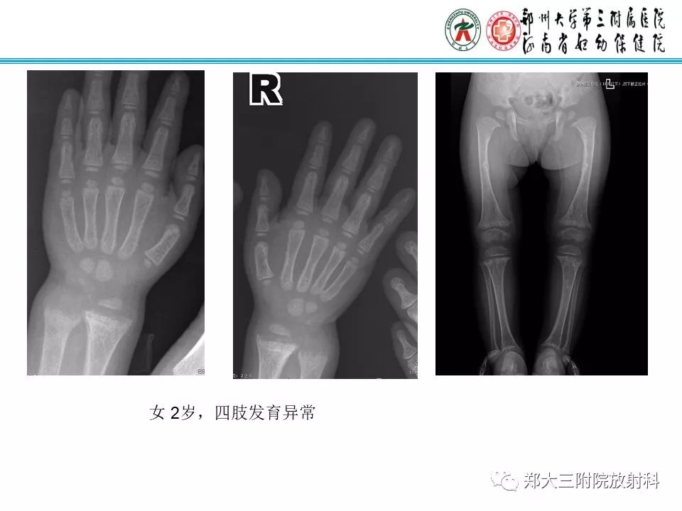 【PPT】佝偻病的影像特点 【PPT】佝偻病的影像特点