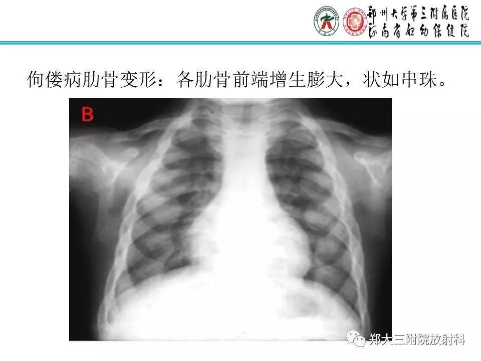【PPT】佝偻病的影像特点 【PPT】佝偻病的影像特点