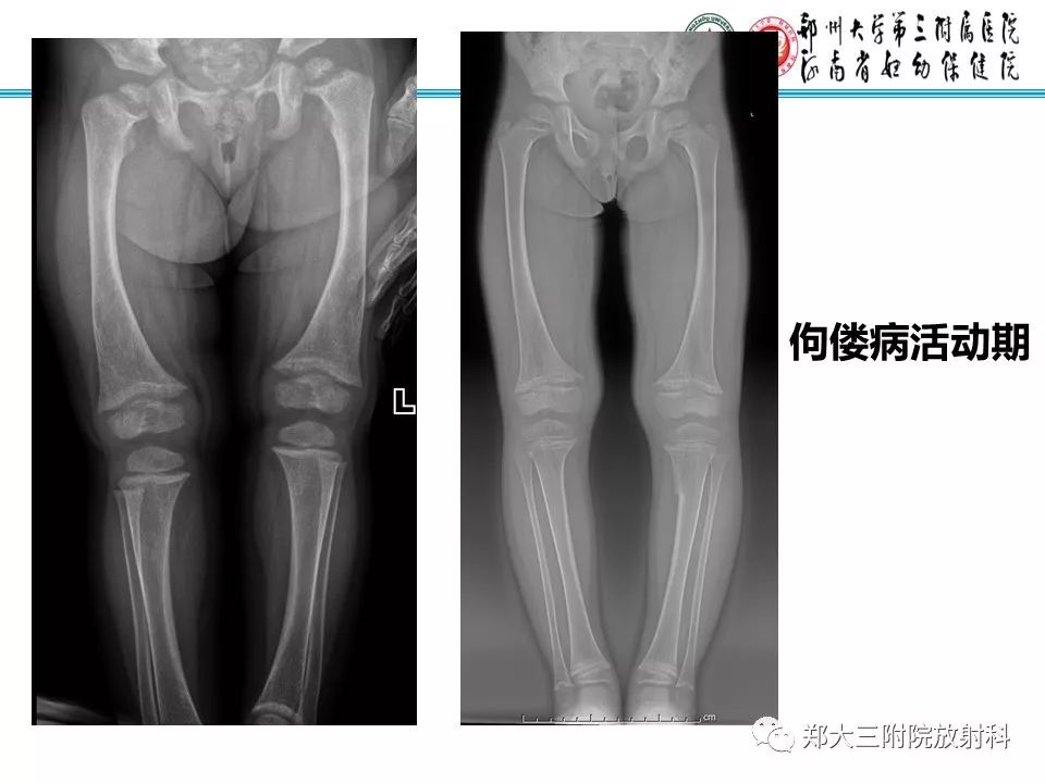 【PPT】佝偻病的影像特点 【PPT】佝偻病的影像特点