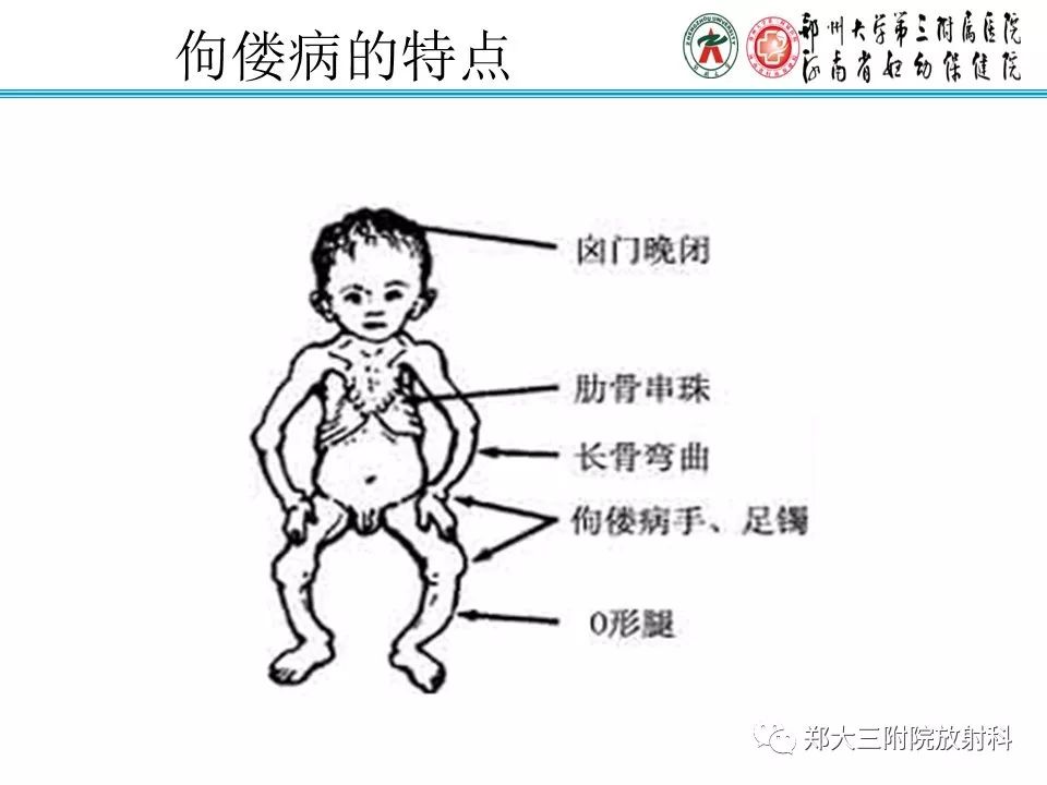 【PPT】佝偻病的影像特点 【PPT】佝偻病的影像特点