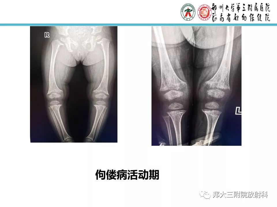【PPT】佝偻病的影像特点 【PPT】佝偻病的影像特点