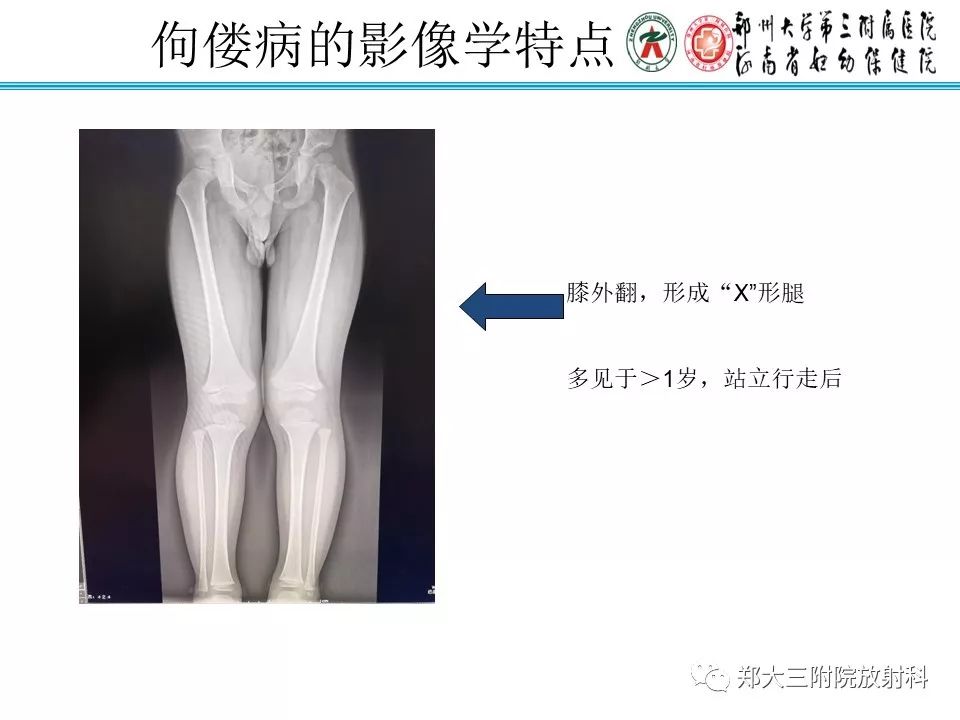 【PPT】佝偻病的影像特点 【PPT】佝偻病的影像特点