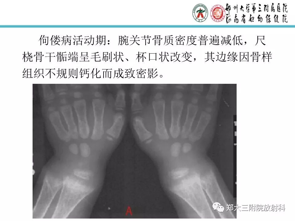 【PPT】佝偻病的影像特点 【PPT】佝偻病的影像特点
