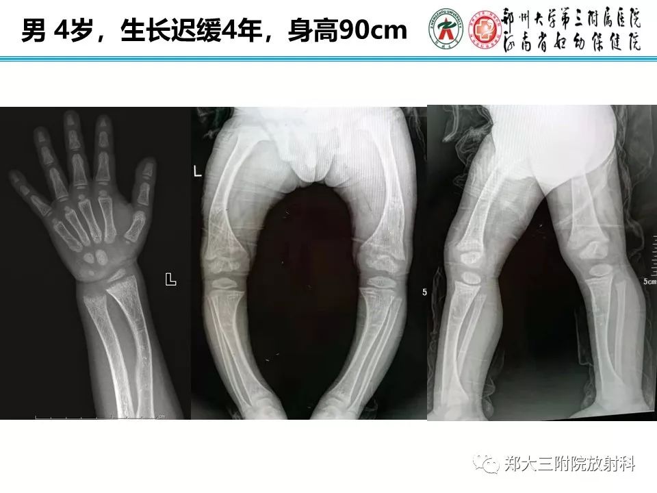 【PPT】佝偻病的影像特点 【PPT】佝偻病的影像特点