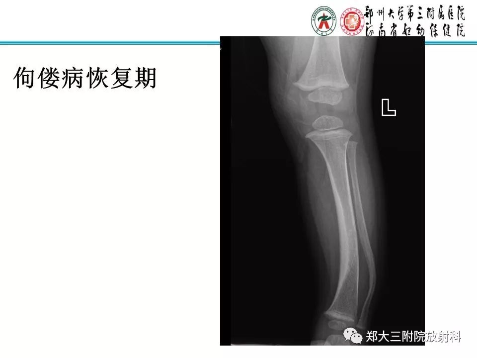 【PPT】佝偻病的影像特点 【PPT】佝偻病的影像特点