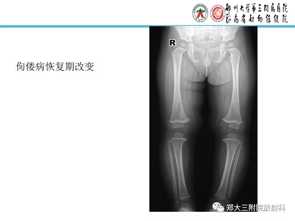 【PPT】佝偻病的影像特点 【PPT】佝偻病的影像特点
