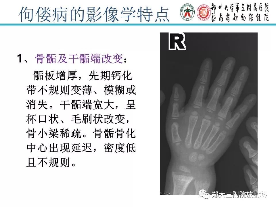 【PPT】佝偻病的影像特点 【PPT】佝偻病的影像特点