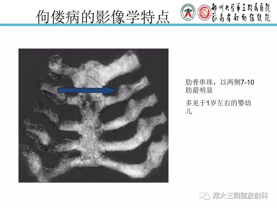 【PPT】佝偻病的影像特点 【PPT】佝偻病的影像特点