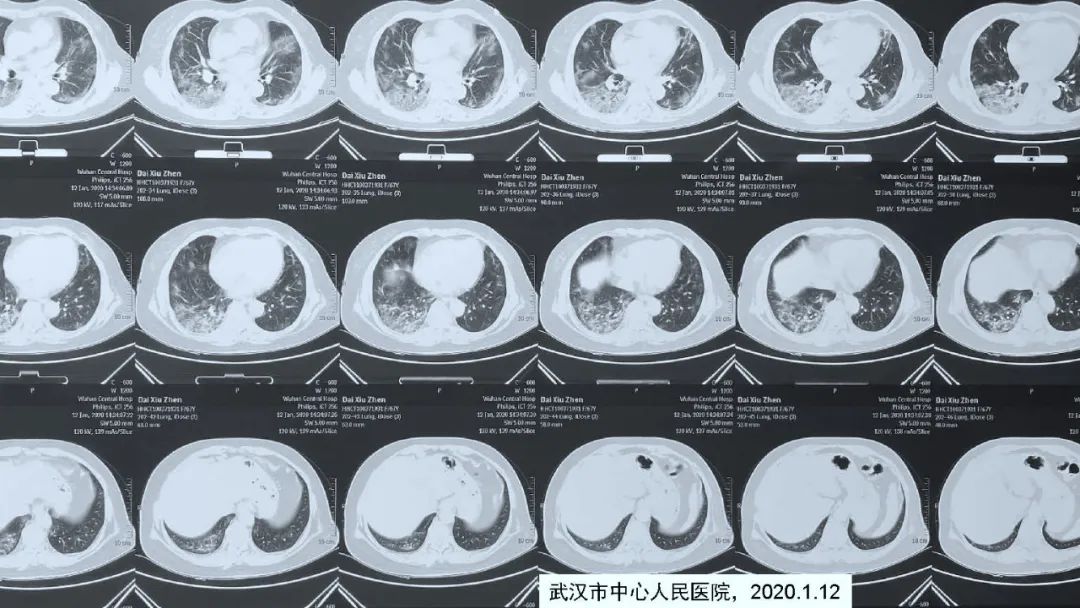 【病例】新冠肺炎2例CT影像