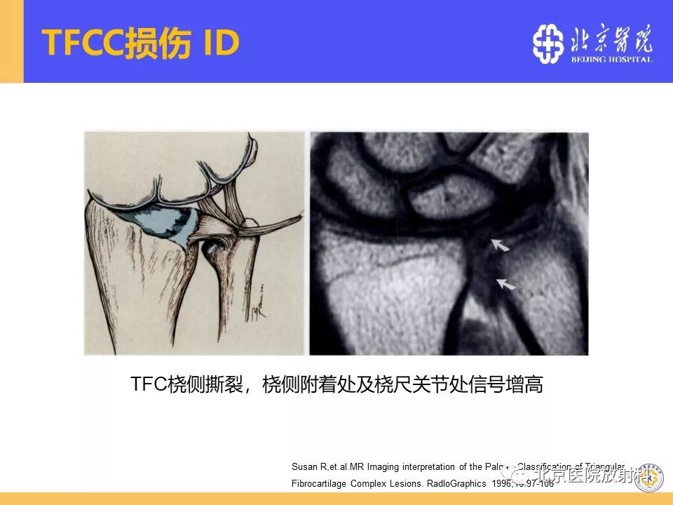 【PPT】三角纤维软骨复合体(TFCC)损伤 【PPT】三角纤维软骨复合体(TFCC)损伤