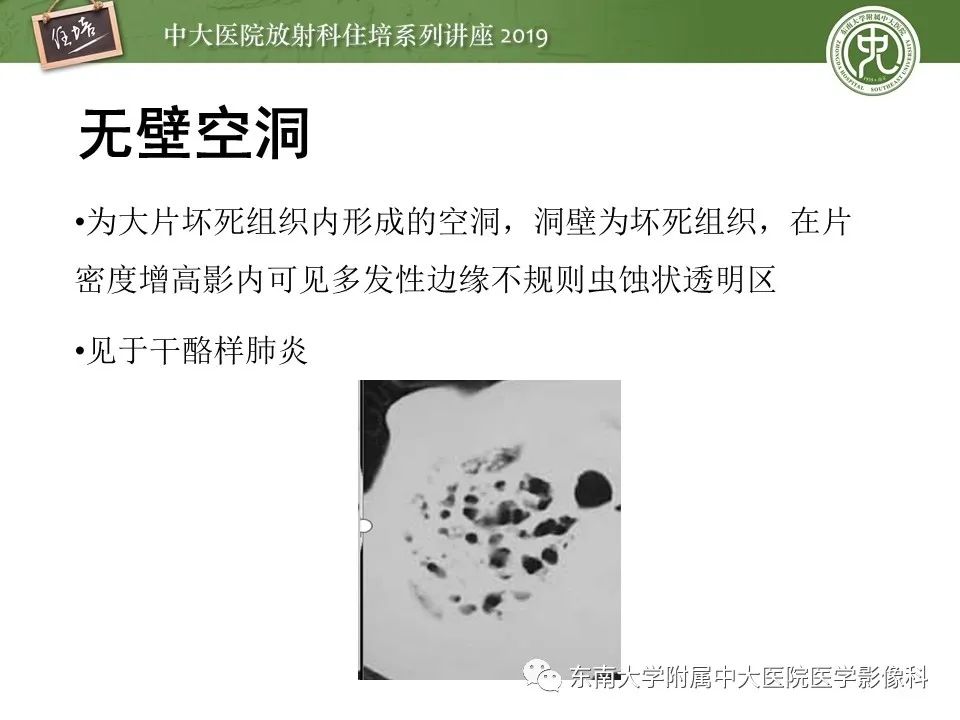 【PPT】肺空洞病变影像诊断及鉴别