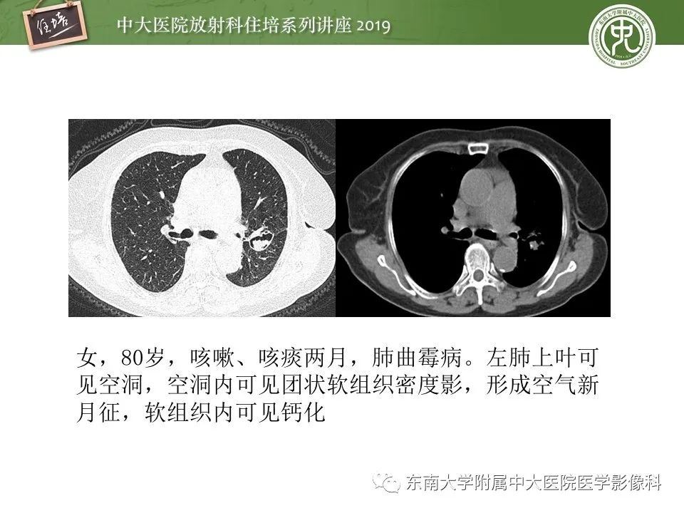 【PPT】肺空洞病变影像诊断及鉴别