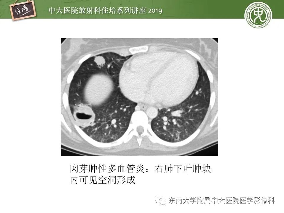 【PPT】肺空洞病变影像诊断及鉴别