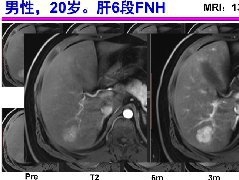 肝脏MRI检查技术规范