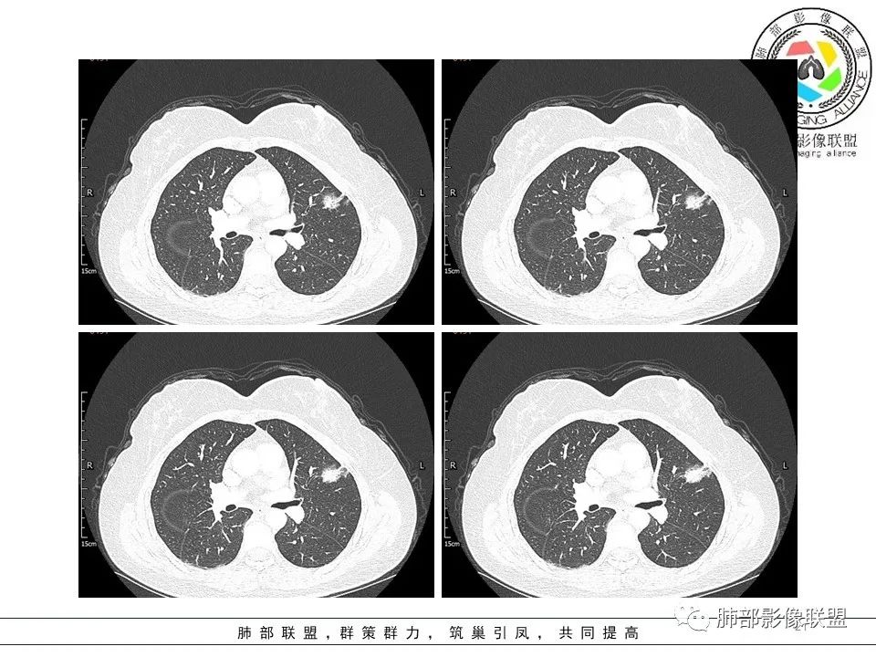 【病例】左肺上叶腺癌1例CT影像讨论