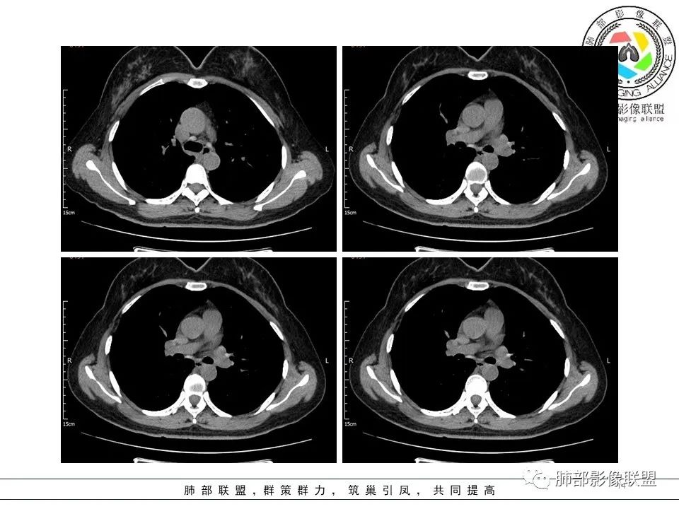 【病例】左肺上叶腺癌1例CT影像讨论