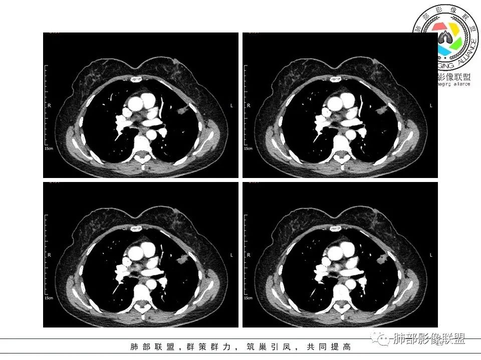 【病例】左肺上叶腺癌1例CT影像讨论